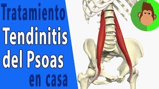 🛑Tendinitis de psoas ilíaco o psoitis  ✅Causas y tratamiento en casa [upl. by Astri]