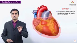 Cardiac Tamponade  causes ECG Diagnosis Pathology Clinical findings Treatment [upl. by Chiang525]