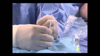 Endovenous Radiofrequency Ablation Set Up Training Video [upl. by Chelsie]