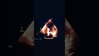 Wall motion abnormalitiesheart attack identification through echo echocardiography heartattack [upl. by Nitsew322]