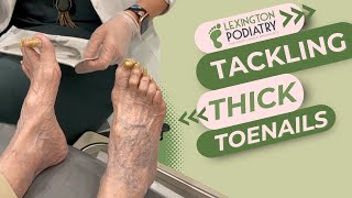 Tackling Thick Toenails [upl. by Llenahc]