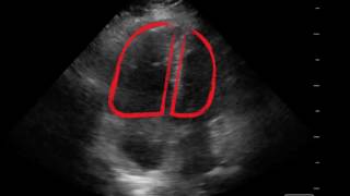 McConnells Sign  PointofCare Echo [upl. by Goulet]