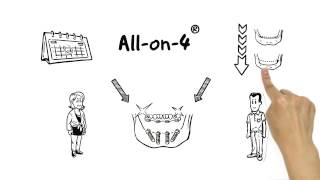 Allon4® treatment concept for failing dentition  Nobel Biocare [upl. by Aizan]