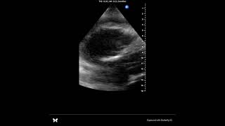 POCUS tamponade [upl. by Arraeic]