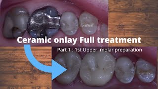 Ceramic onlay full treatment  Part 1 1st upper molar preparation [upl. by Fisher3]