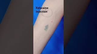 xylocaine injection viralshort video [upl. by Yebot]