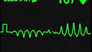 Torsades de Pointes  ECG Simulator  Arrhythmia Simulator [upl. by Lovell]