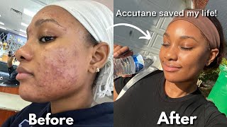 MY 6 MONTH ACCUTANE JOURNEY  side effects purging amp skin care routine  Ice Diallo [upl. by Branca366]