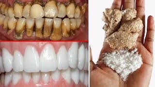 In Just Two MinutesWhite Teeth Whiten And Shiny Like PearlsThis Recipe [upl. by Hamlen827]