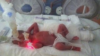 Born at 25 Weeks MicroPreemie Documentary [upl. by Eissed133]