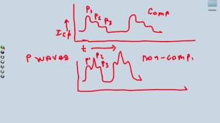 Intracranial Monitoring Supplemental Video [upl. by Posehn725]