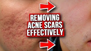 GET RID OF ACNE SCARS FROM EXPERIENCE [upl. by Brottman]