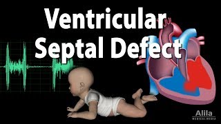 Ventricular Septal Defect Animation [upl. by Aenet]