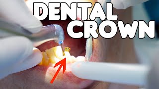 Dental Crown Procedure EXPLAINED [upl. by Guglielma188]