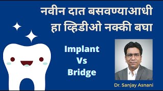 Dental Implant Vs Bridge  Explained in Marathi  Dr Sanjay Asnani Ahmednagar  Sai Care Dental [upl. by Naima661]