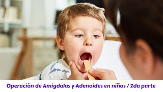 Operación de amigdalas y adenoides en niños  2da parte [upl. by Wickner]