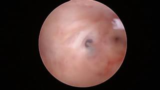 Histeroscopia diagnóstica  Diagnostic hysteroscopy [upl. by Kippie]