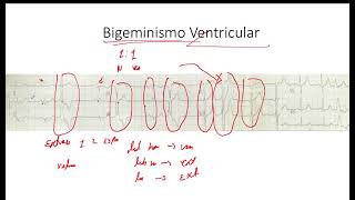 Bigeminismo y Trigeminismo  Extrasistole Auricular y Ventricular EKG [upl. by Briscoe]