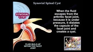 Synovial Cyst Of The Spine  Everything You Need To Know  Dr Nabil Ebraheim [upl. by Brew]