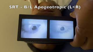 Apogeotropic Horizontal Canal BPPV [upl. by Dong326]