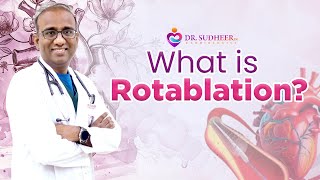 What is Rotablation Dr Sudheer Koganti [upl. by Teiluj230]