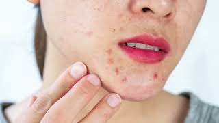 Uncover the Truth Behind Skin Spots Petechiae [upl. by Staley861]