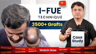 Hair Transplant in Hyderabad  Cost of Hair Transplant And Hair Transplant Doctor in Hyderabad [upl. by Elleinnod]