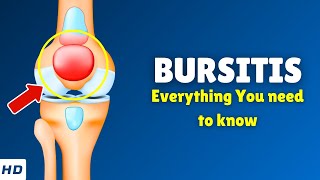 Bursitis – Types Causes Signs and Symptoms Diagnosis amp Treatment [upl. by Eanram438]