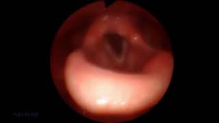 Sleep Unilateral Vocal Cord Paresis [upl. by Wesa]