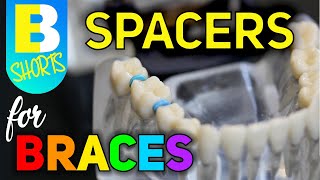 Spacers for Braces shorts [upl. by Sigsmond]