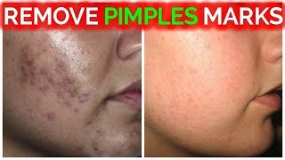 Remove Pimple Marks  Acne Marks  Dark Spots  Black Spots Fast At Home Remedies Rabia Skin Care [upl. by Nahgiem]