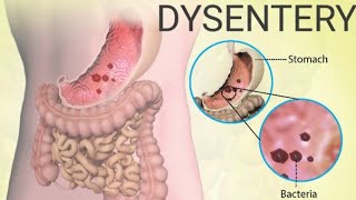 What is Dysentery Bacillary dysentery Amoebic dysentery DysenterysymptomsDiagnosis Treatment [upl. by Schaab]