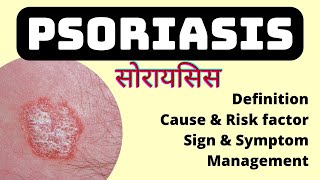 psoriasis skin disease in hindi  Cause risk factor symptoms and treatment  MSN  soriasis [upl. by Tildi240]