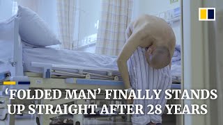 ‘Folded man’ stands up straight after 28 years following surgery that broke bones [upl. by Ayatahs]