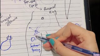 Femoral Hernia  All you need to know EASY TO UNDERSTAND [upl. by Lower]