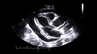 Pericardial Tamponade From a Fractured Inferior Vena Cava IVC Stent [upl. by Rankin806]