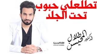 العلاج المثالي للحبوب تحت الجلد  لا تضيع وقتك في حلول أخرى [upl. by Odranreb4]