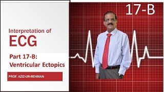 ECG Part 17 B Ventricular Ectopics Couplets Triplets amp R on T Phenomenon [upl. by Ardys64]