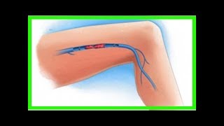 Symptômes d’une thrombose veineuse dans les jambes [upl. by Mccormac]