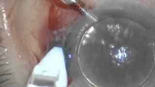 Sutureless DSEAK cornea transplantation using and ocular sealant Resure2011 [upl. by Ilan]