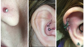 How do I get rid of a Keloid  hypertrophic scar aka piercing bump [upl. by Anailuy]