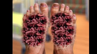 Injury Toe Treatment। Deep Cleaning। Relaxing Toe Clean । Fungas Remove [upl. by Chariot]