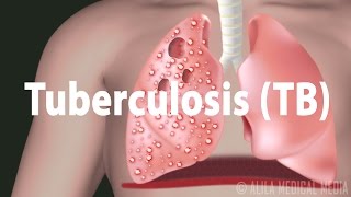 Tuberculosis TB Progression of the Disease Latent and Active Infections [upl. by Eilram]