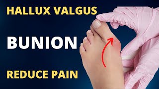 Hallux Valgus Treatment without Surgery [upl. by Colinson866]