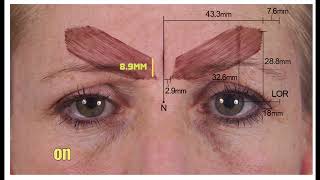 Indepth Guide To Treating The GlabellaForehead With Botox  Dr Chris Hutton [upl. by Yramanna827]