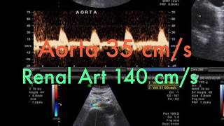 TMT RENAL DOPPLER PART IV  Renal To Aortic Ratio [upl. by Namyh307]