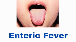 Enteric Fever  Clinical Features amp Management [upl. by Aloin]