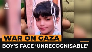 Injured Palestinian boy in Gaza no longer recognises his own face  Al Jazeera NewsFeed [upl. by Ettelliw735]