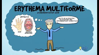 Erythema multiforme [upl. by Ynaffat]