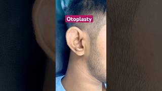 Otoplasty  Ear pinning  doctor laserclinic earshaping earpining beauty skincare fatloss [upl. by Nyleahcim]